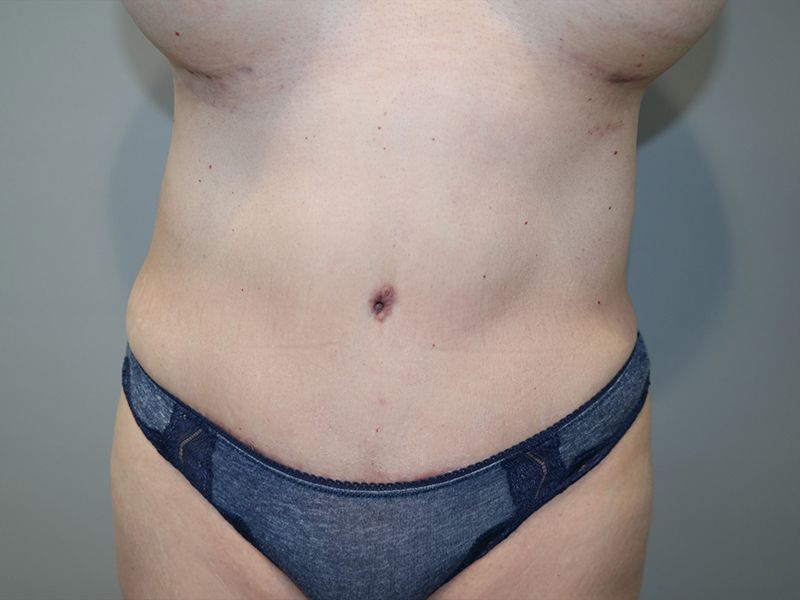 Tummy Tuck Before and After | Grover Aesthetics