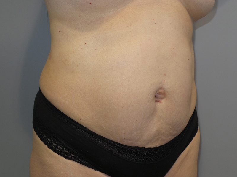 Tummy Tuck Before and After 118 | Grover Aesthetics