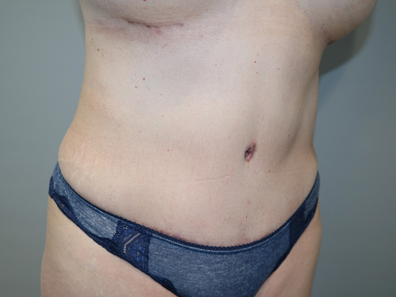 Tummy Tuck Before and After 118 | Grover Aesthetics