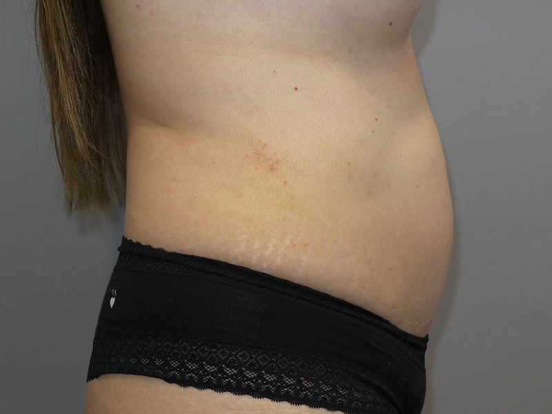 Tummy Tuck Before and After 118 | Grover Aesthetics
