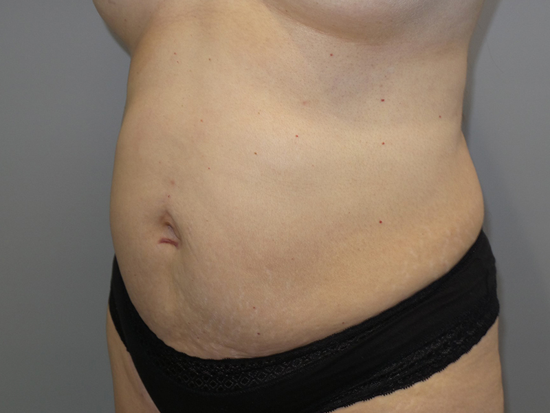 Tummy Tuck Before and After 118 | Grover Aesthetics