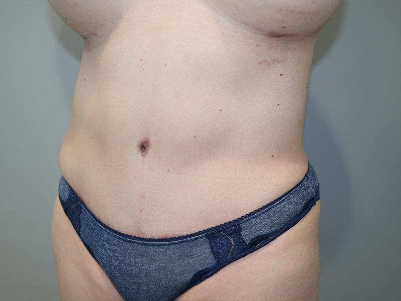 Tummy Tuck Before and After 118 | Grover Aesthetics