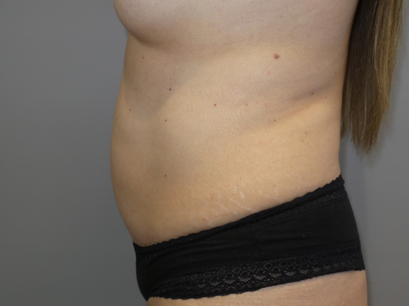 Tummy Tuck Before and After 118 | Grover Aesthetics