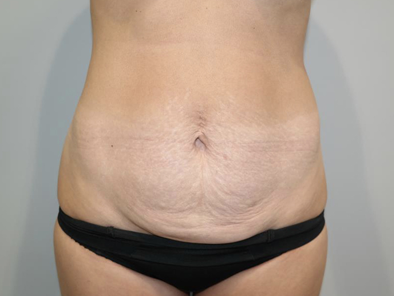 Tummy Tuck Before and After | Grover Aesthetics