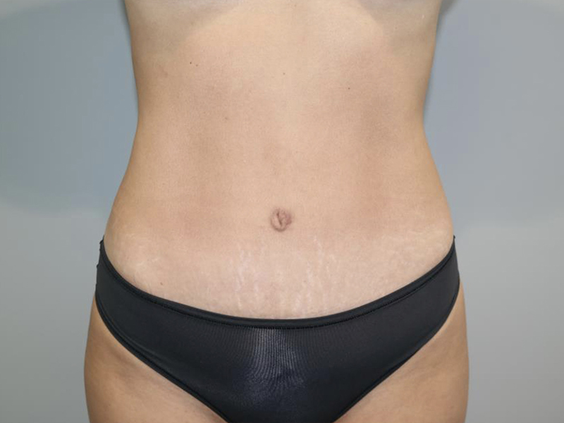 Tummy Tuck Before and After | Grover Aesthetics