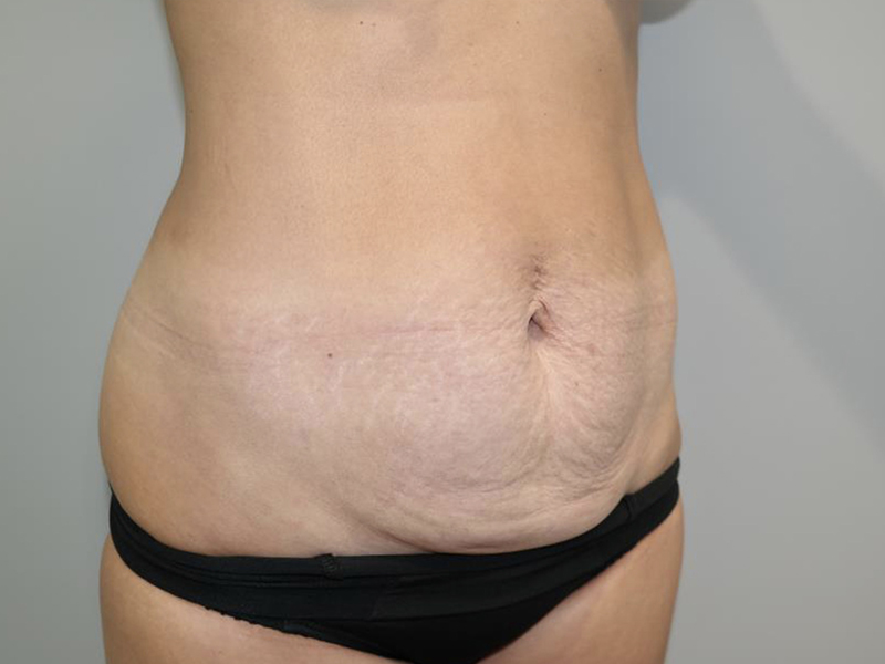 Tummy Tuck Before and After 119 | Grover Aesthetics