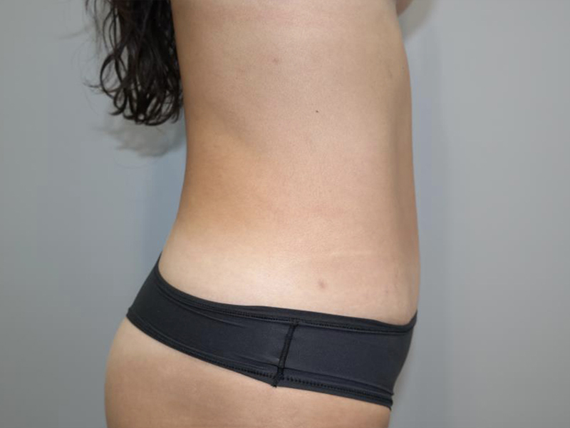 Tummy Tuck Before and After 119 | Grover Aesthetics