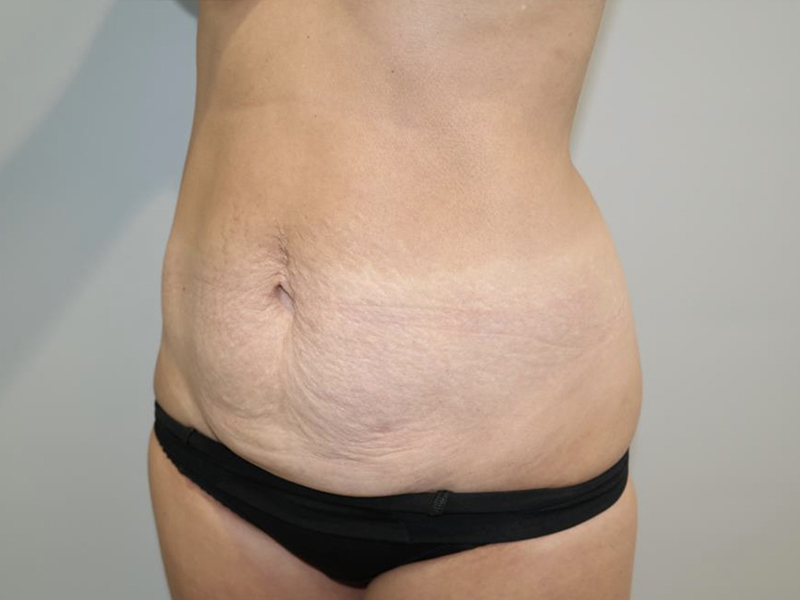 Tummy Tuck Before and After 119 | Grover Aesthetics