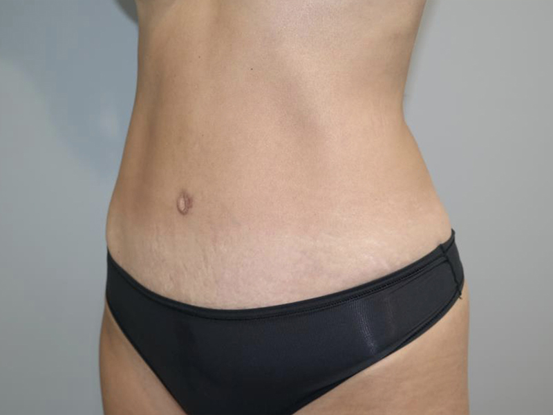 Tummy Tuck Before and After 119 | Grover Aesthetics