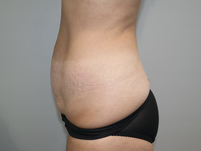 Tummy Tuck Before and After 119 | Grover Aesthetics