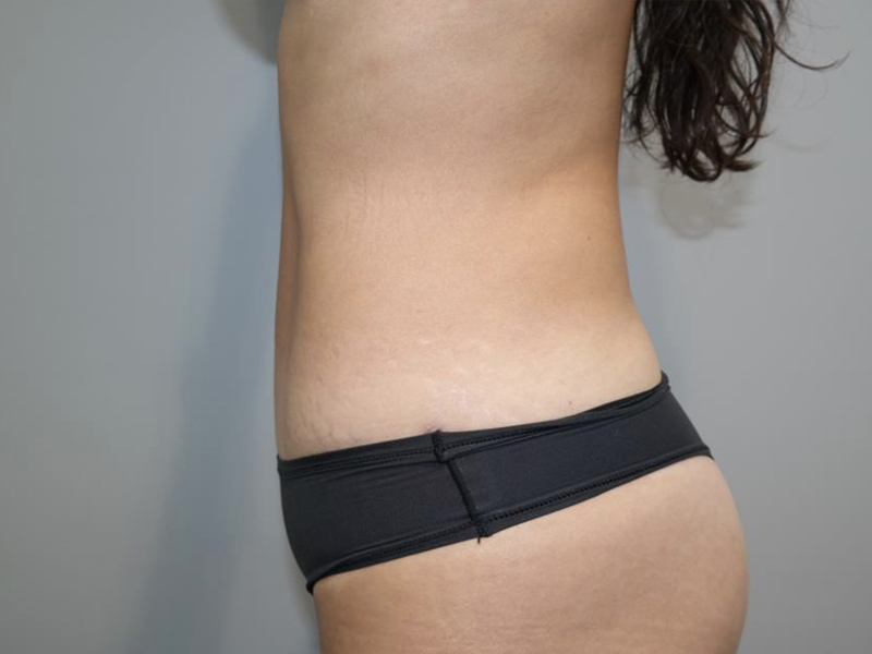 Tummy Tuck Before and After 119 | Grover Aesthetics