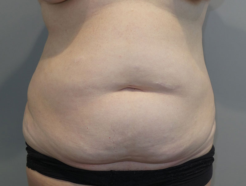 Tummy Tuck Before and After 60 | Sanjay Grover MD FACS