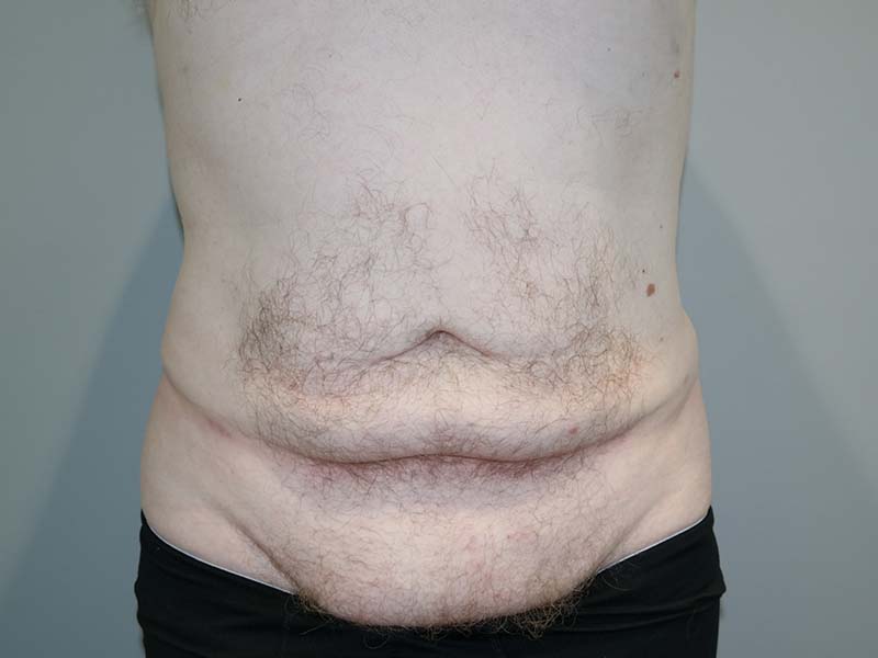 Tummy Tuck Before and After | Grover Aesthetics