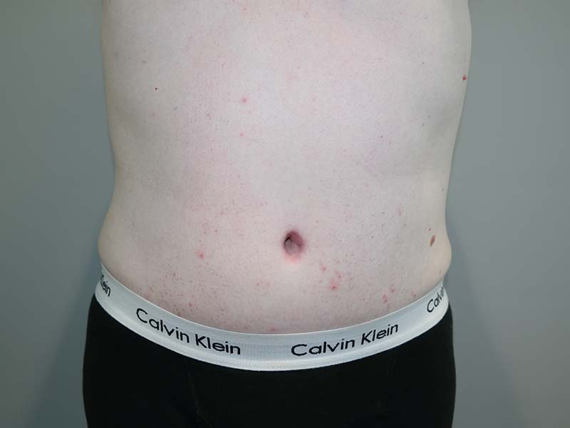 Tummy Tuck Before and After | Grover Aesthetics