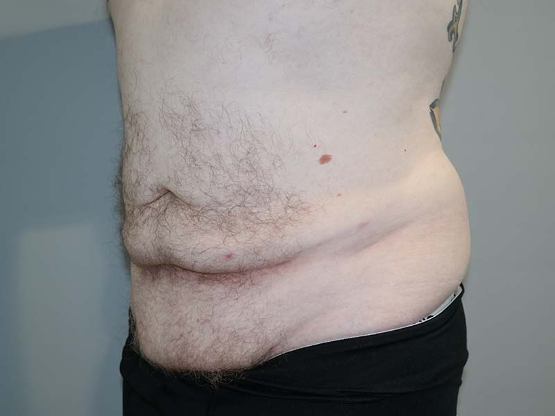 Tummy Tuck Before and After 12 | Sanjay Grover MD FACS