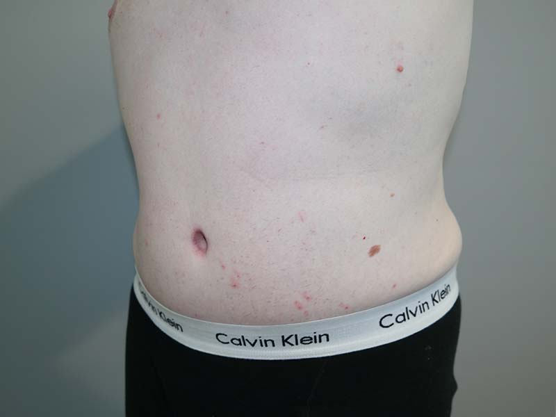Tummy Tuck Before and After 12 | Grover Aesthetics