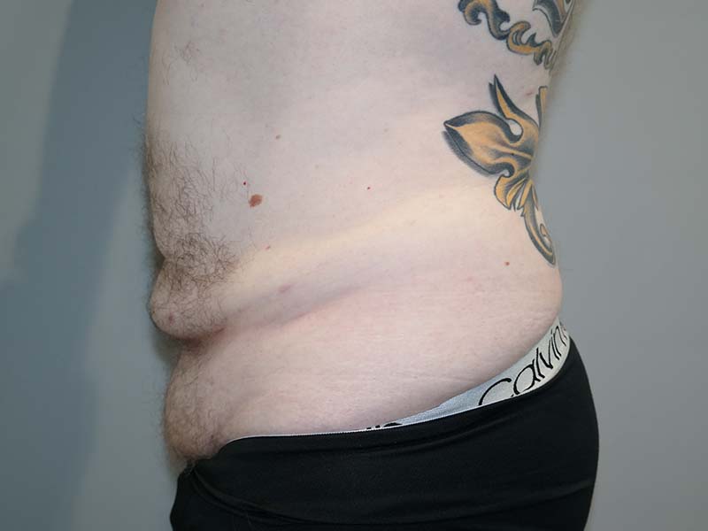 Tummy Tuck Before and After 12 | Grover Aesthetics