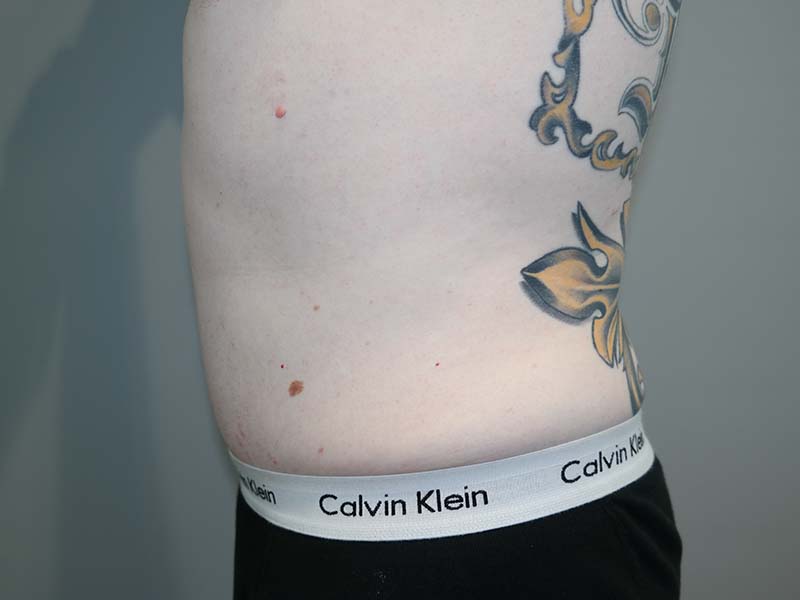 Tummy Tuck Before and After 12 | Grover Aesthetics