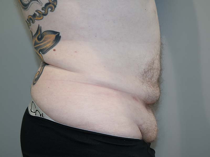 Tummy Tuck Before and After 12 | Grover Aesthetics
