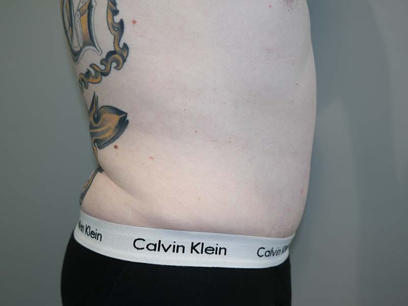 Tummy Tuck Before and After 12 | Grover Aesthetics