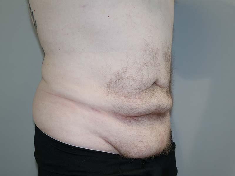 Tummy Tuck Before and After 12 | Sanjay Grover MD FACS