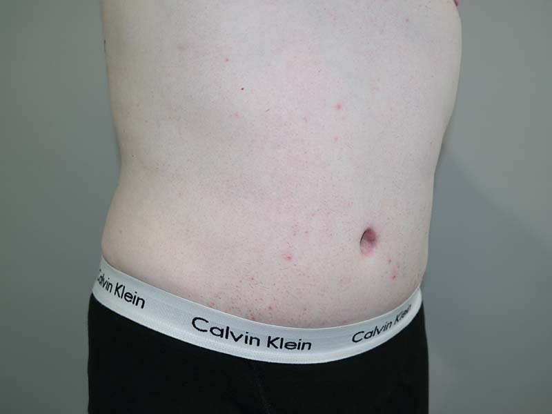 Tummy Tuck Before and After 12 | Grover Aesthetics