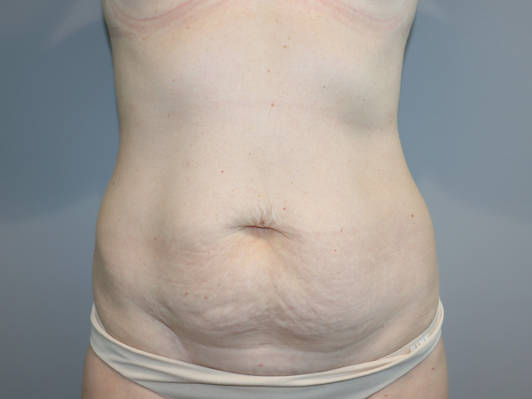 Tummy Tuck Before and After | Grover Aesthetics
