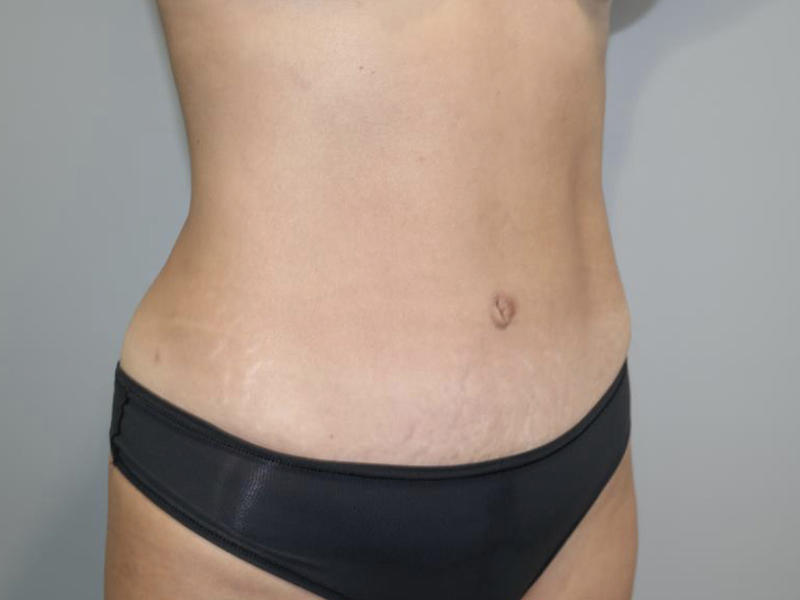Tummy Tuck Before and After 121 | Grover Aesthetics