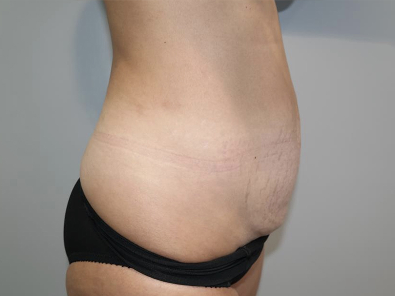 Tummy Tuck Before and After 121 | Grover Aesthetics