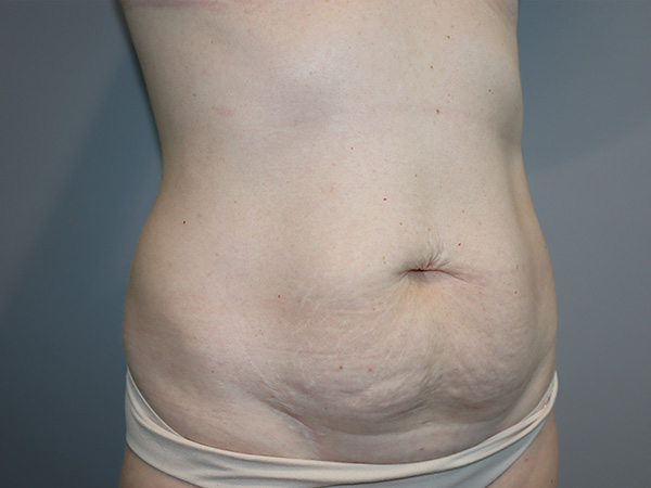 Tummy Tuck Before and After 122 | Grover Aesthetics
