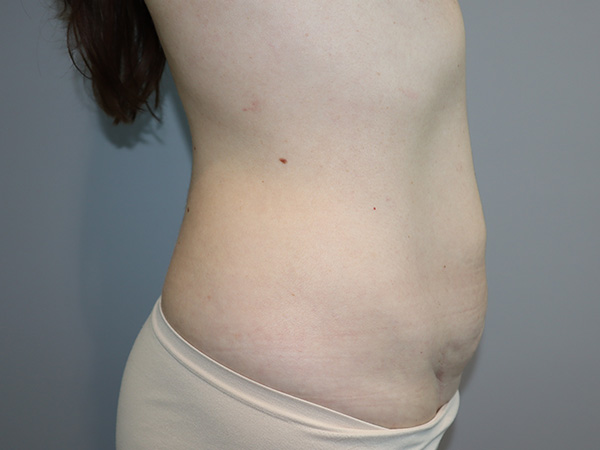 Tummy Tuck Before and After 122 | Grover Aesthetics