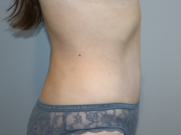 Tummy Tuck Before and After 122 | Grover Aesthetics