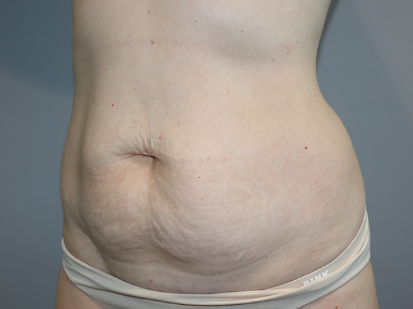 Tummy Tuck Before and After 122 | Grover Aesthetics