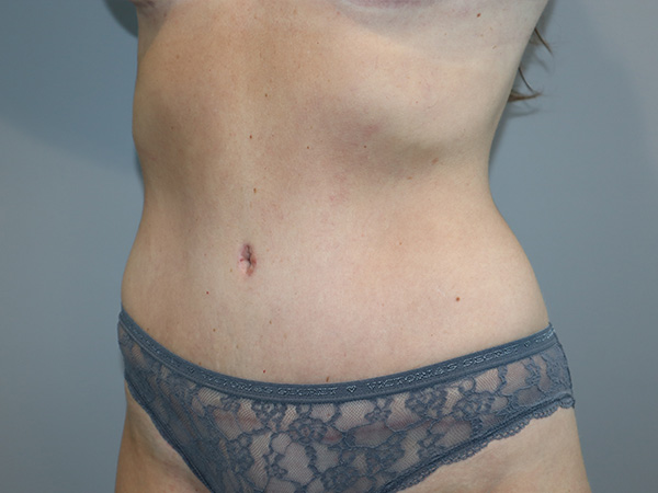 Tummy Tuck Before and After 122 | Grover Aesthetics
