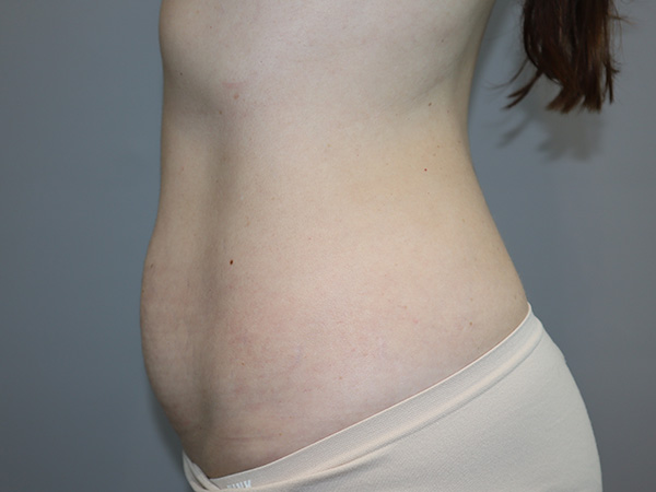 Tummy Tuck Before and After 122 | Grover Aesthetics