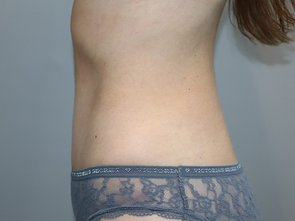 Tummy Tuck Before and After 122 | Grover Aesthetics