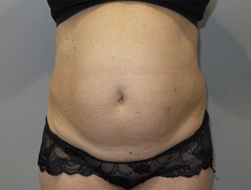 Tummy Tuck Before and After | Grover Aesthetics