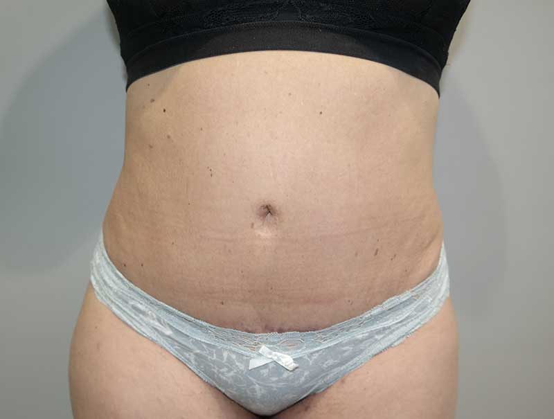 Tummy Tuck Before and After | Grover Aesthetics