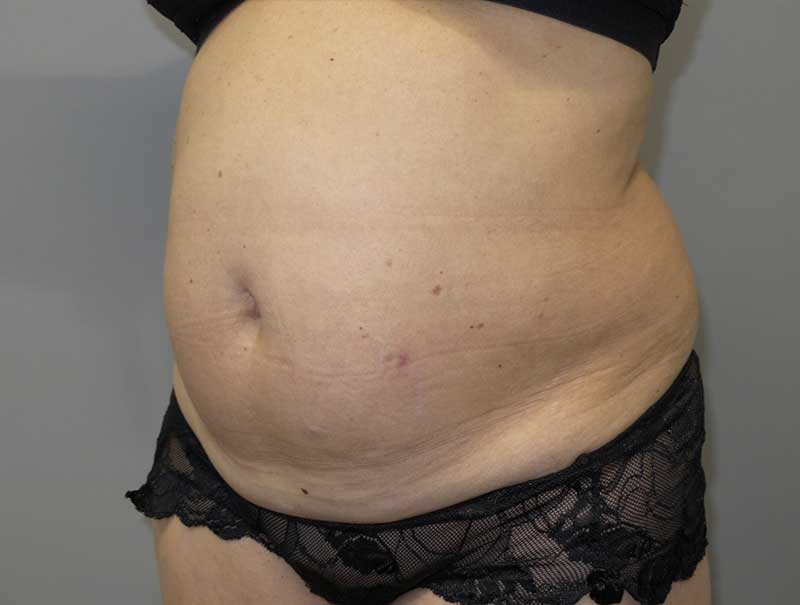 Tummy Tuck Before and After 13 | Grover Aesthetics