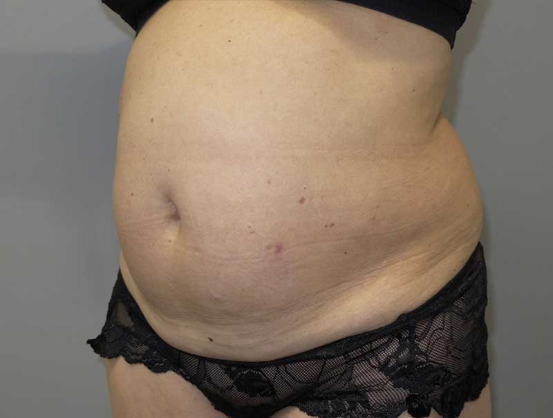 Tummy Tuck Before and After 13 | Sanjay Grover MD FACS