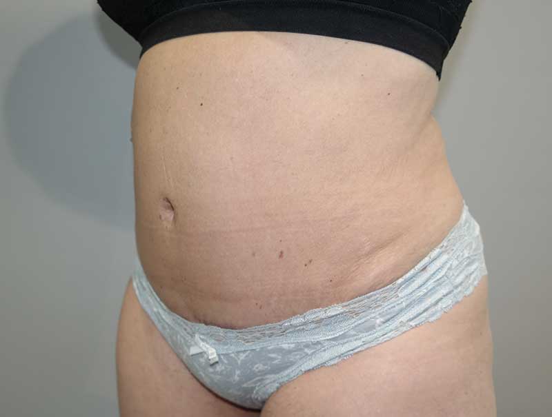 Tummy Tuck Before and After 13 | Sanjay Grover MD FACS