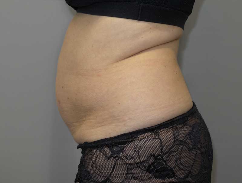 Tummy Tuck Before and After 13 | Sanjay Grover MD FACS