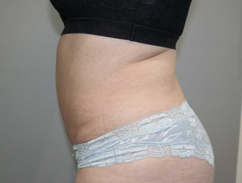 Tummy Tuck Before and After 13 | Sanjay Grover MD FACS