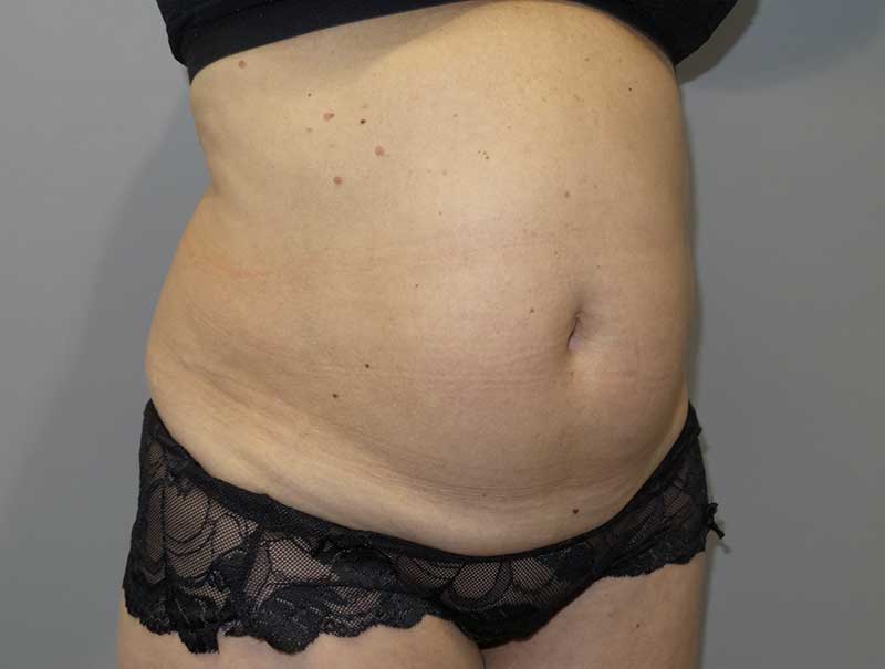 Tummy Tuck Before and After 13 | Sanjay Grover MD FACS