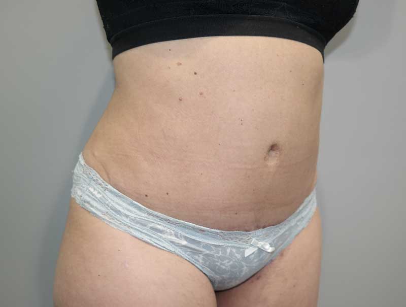 Tummy Tuck Before and After 13 | Sanjay Grover MD FACS