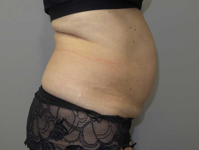 Tummy Tuck Before and After 13 | Sanjay Grover MD FACS