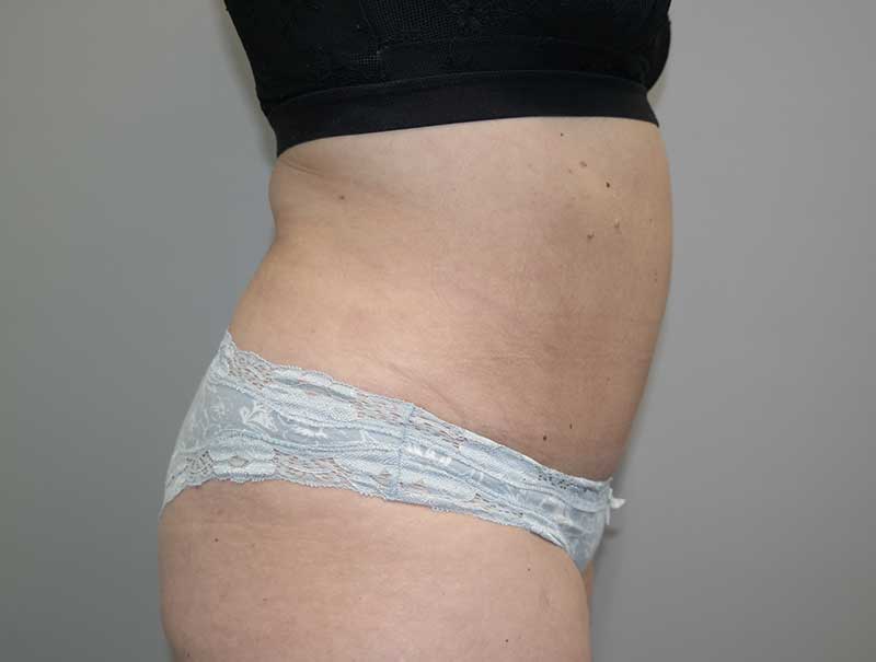 Tummy Tuck Before and After 13 | Sanjay Grover MD FACS