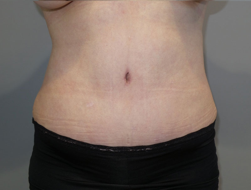 Tummy Tuck Before and After 14 | Sanjay Grover MD FACS