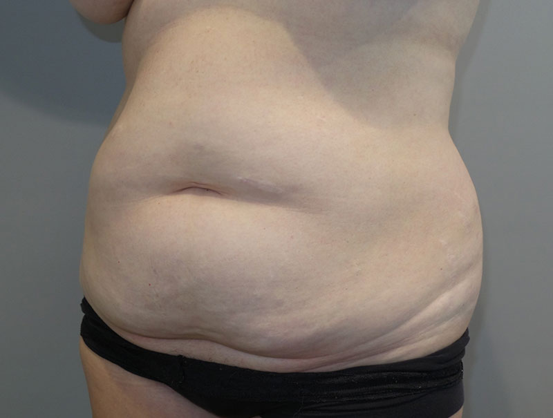 Tummy Tuck Before and After 14 | Sanjay Grover MD FACS