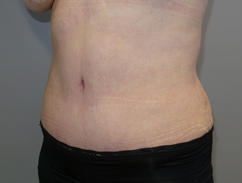 Tummy Tuck Before and After 14 | Sanjay Grover MD FACS